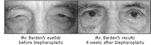 Ocala Eye blepharoplasty