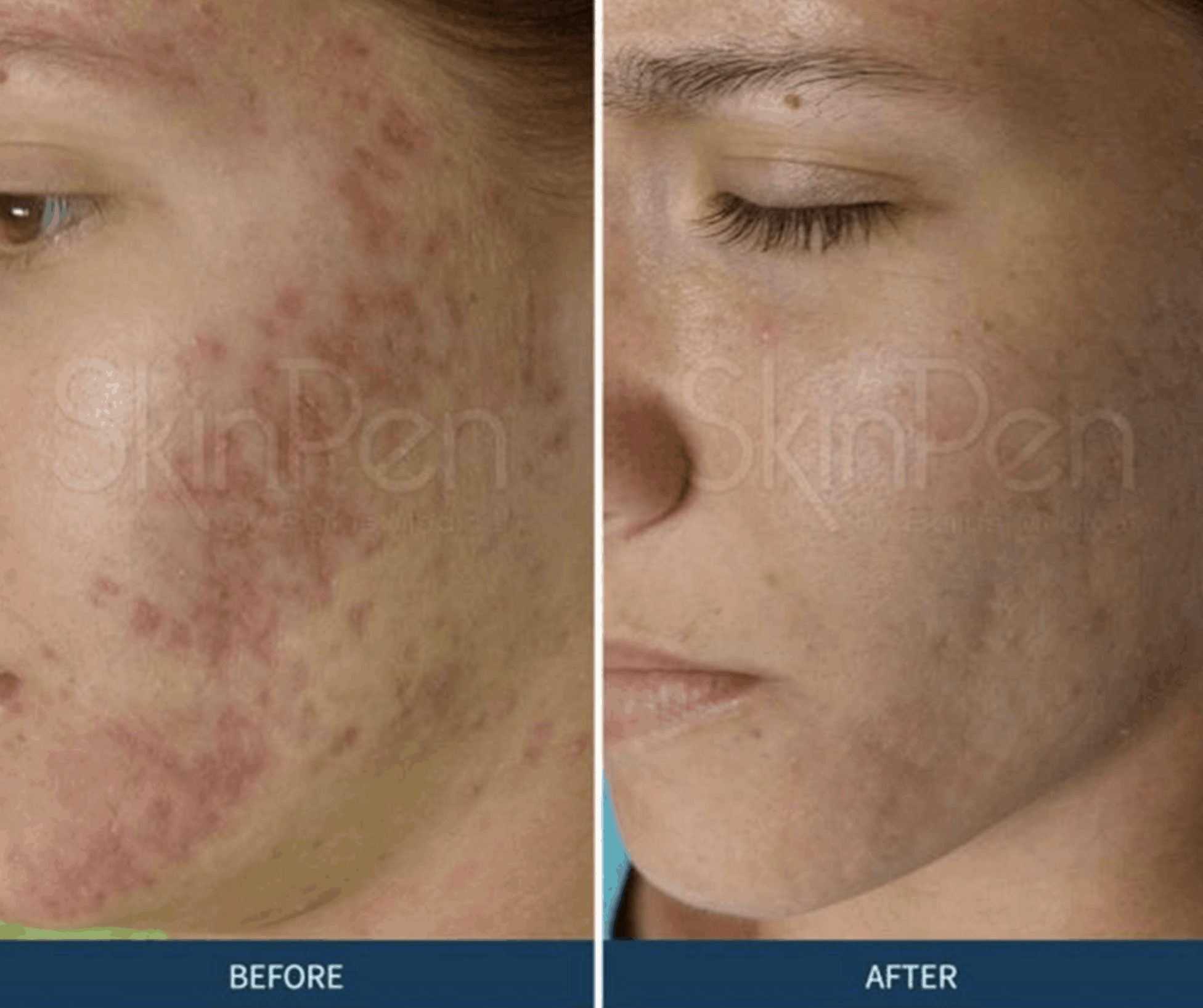SkinPen Collagen Induction Therap