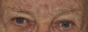 Picture of man's eyes after oculoplastic surgery