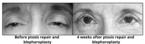 ptosis repair before and after