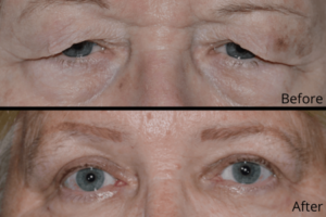 What are the different types of eyelid surgeries