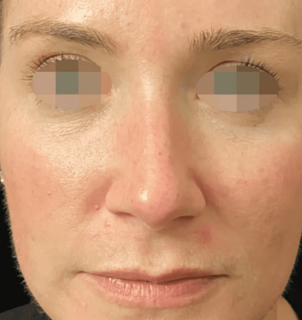 Opus Plasma Skin Resurfacing Ocala Eye