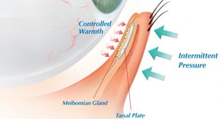 lipiflow