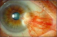 Ocala Eye pterygium