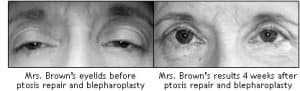 Ocala Eye blepharoplasty