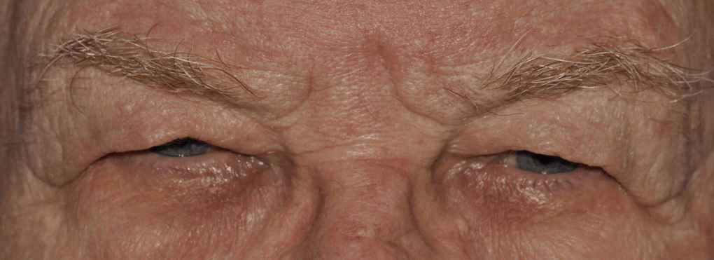 Picture of man's eyes before oculoplastic surgery
