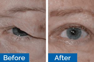 Two eyes showing the before and after of cosmetic eyelid surgery