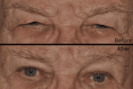 What does blepharoplasty clearance mean