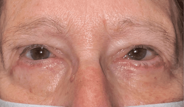 Can Under Eye Bags be Removed Without Surgery? - Ocala Eye