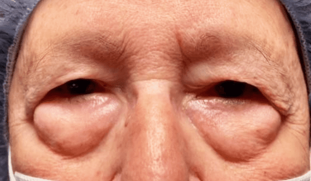 Bags Under Your Eyes Causes  Treatments to Reduce UnderEye Bags