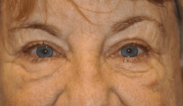 Can Under Eye Bags be Removed Without Surgery? - Ocala Eye