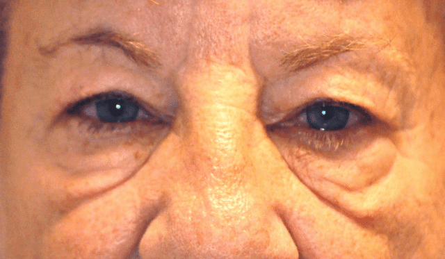 Can Under Eye Bags be Removed Without Surgery? - Ocala Eye